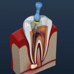 Tips To Choose The Right Dentist For Root Canal