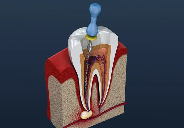 Tips To Choose The Right Dentist For Root Canal